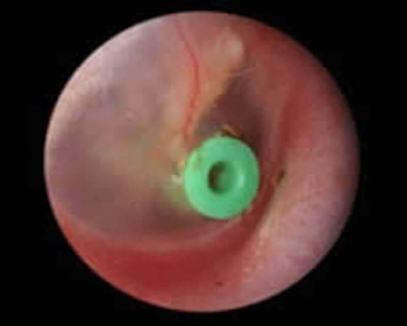 Grommets for glue ear drainage