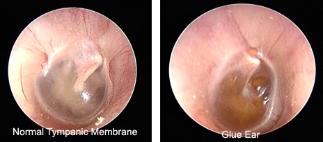 glue ear normal tympanic membrane