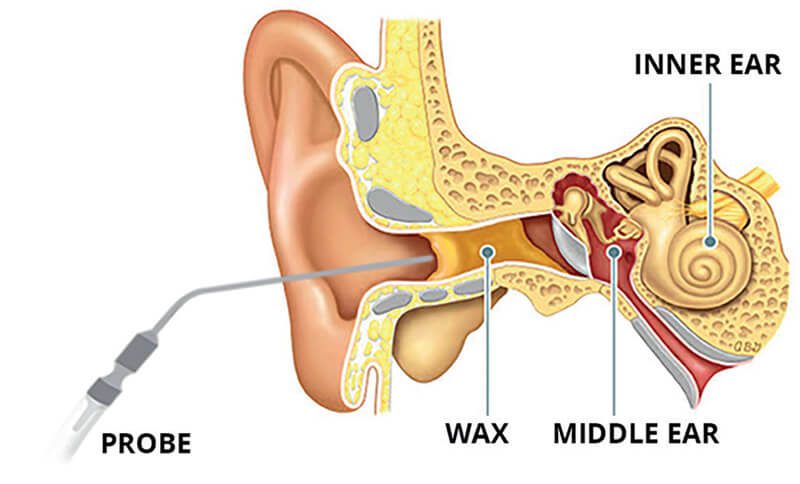 Microsuction ear wax removal
