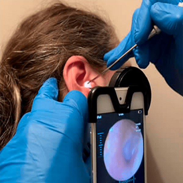 Endoscopic ear wax removal